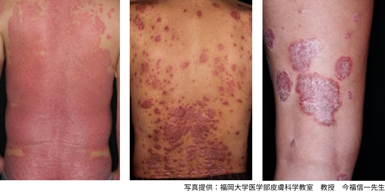 乾癬に関する 7 つの誤解と真実